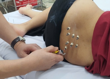 Điều trị rối loạn tiểu tiện theo phương pháp đông y